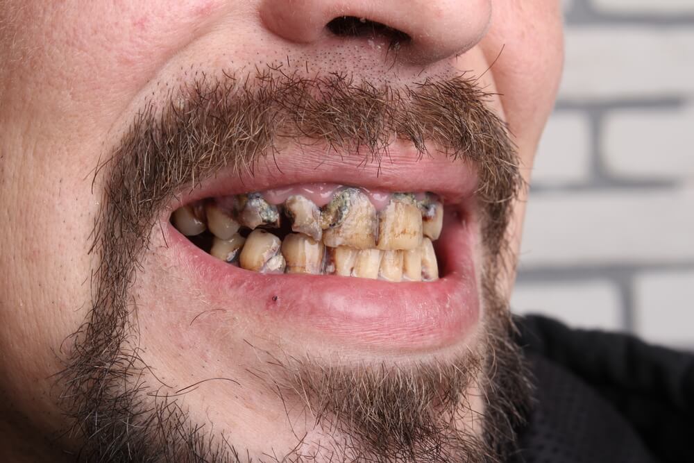 Разрушение зубов